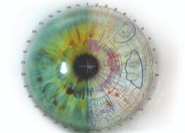 Diagnostico-por-el-iris