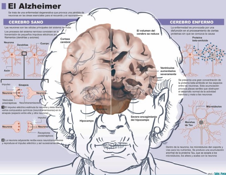 cerebro en el alzheimer